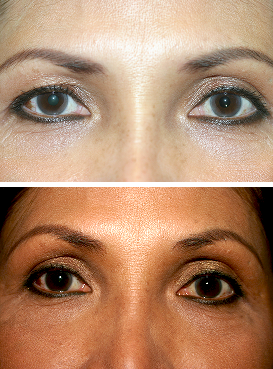 Eyelid Surgery Before & After