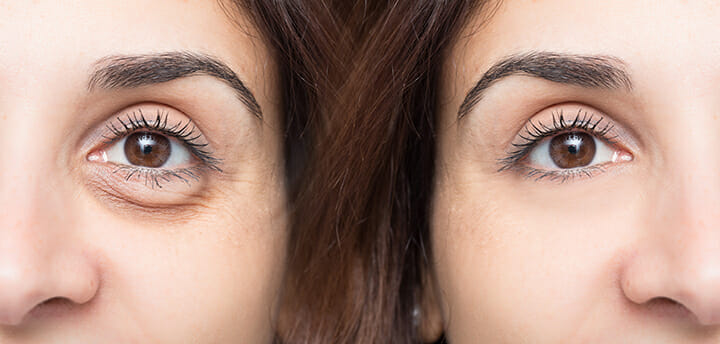 Eyelid Surgery Murrieta